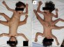 'Gêmeos aranha': siameses que nasceram com sete membros passam por cirurgia - Reprodução/American Journal of Case Reports