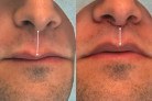 Lip Lift amplia opções de rejuvenescimento sem volume -  (crédito:  drfabiobarros.com.br)