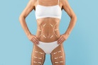  Liposuction Treatment. Cropped Shot Of Slim Young Female Body With Drawn Lifting Up Lines On It, Unrecognizable Lady In White Underwear Standing Isolated Over Blue Background, Collage With Copy Space
     -  (crédito: DINO)