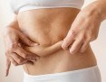 Tecnologia melhora retração da pele após lipoaspiração - (crédito: DINO) Tecnologia melhora retração da pele após lipoaspiração - (crédito: DINO)