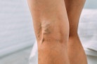 Legs with woman with varicose veins and pronounced mesh.
- (crédito: BABENKO S) Legs with woman with varicose veins and pronounced mesh.
- (crédito: BABENKO S)