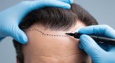  Close-up view of a man's head showing a marked hairline during a pre-hair transplant consultation, with gloved hands preparing for the procedure
     -  (crédito: DINO)