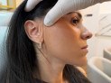 Lifting facial endoscópico dispensa cicatriz visível - (crédito: DINO) Lifting facial endoscópico dispensa cicatriz visível - (crédito: DINO)
