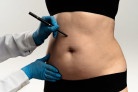 Lipoaspiração lidera preferência por cirurgias plásticas - (crédito: DINO) Lipoaspiração lidera preferência por cirurgias plásticas - (crédito: DINO)