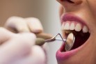 Sangramento na gengiva pede avaliação, alerta dentista - (crédito: DINO) Sangramento na gengiva pede avaliação, alerta dentista - (crédito: DINO)