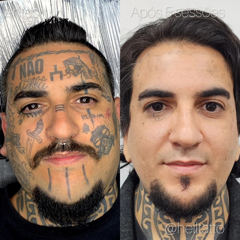 Remoção de tatuagem cresce e muda perfil de quem procura -  (crédito: DINO)
