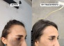 Nevo de Ota pode ser tratado com laser, explica biomédico -  (crédito: DINO)