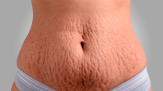 Cirurgia plástica e estética se aliam contra as estrias - (crédito: DINO) Cirurgia plástica e estética se aliam contra as estrias - (crédito: DINO)