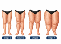 Lipoaspiração de pernas auxilia no tratamento do lipedema
- (crédito: DINO) Lipoaspiração de pernas auxilia no tratamento do lipedema
- (crédito: DINO)
